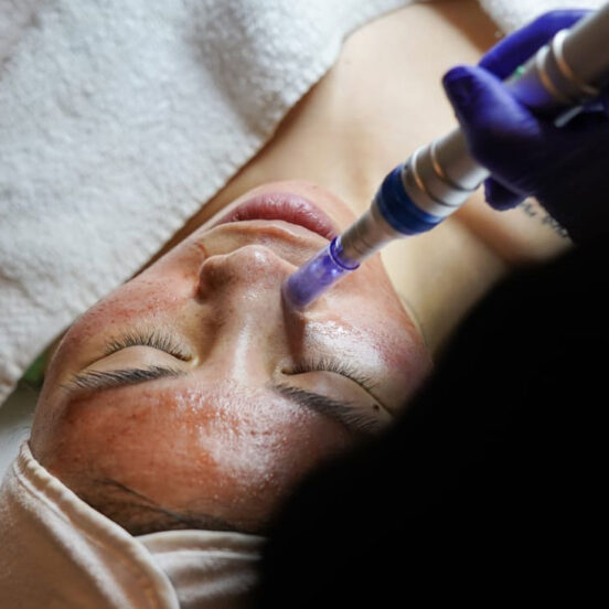 Microneedling Arlington Va