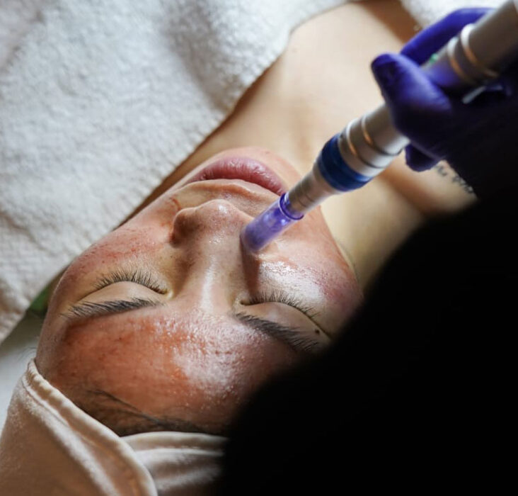 Microneedling Arlington Va