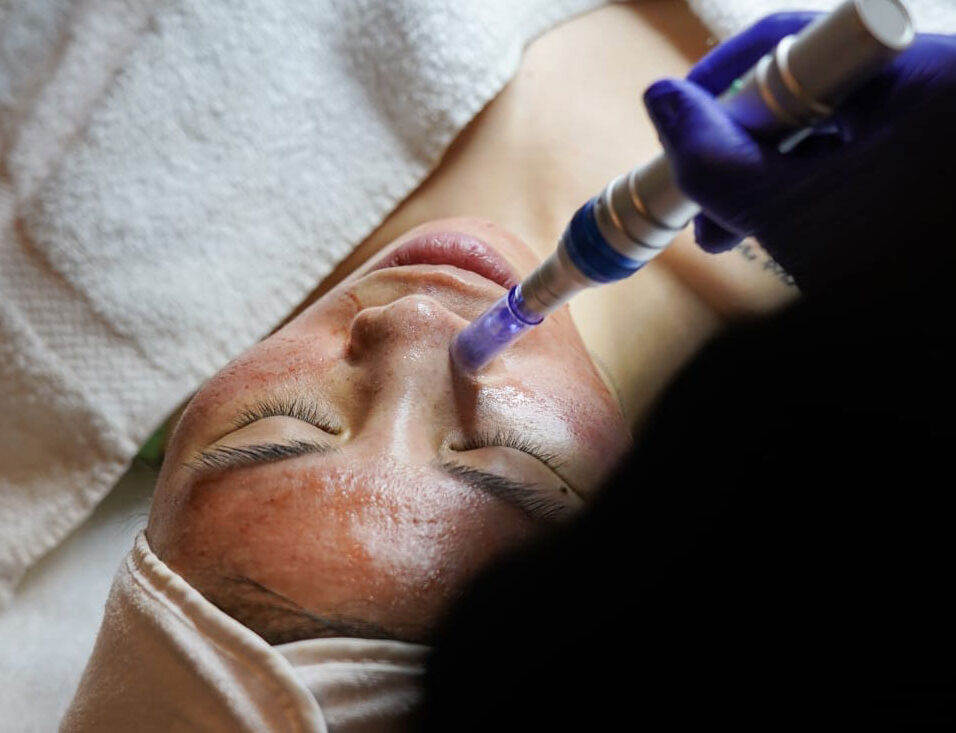 Microneedling Arlington Va