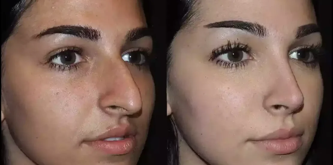 Who is the Best Septoplasty Surgeon in Dubai Today?