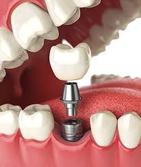 affordable dental bridges near me