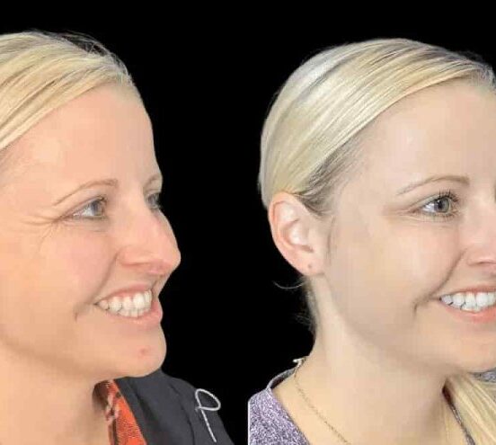 Understanding the Cost of Botox in Dubai