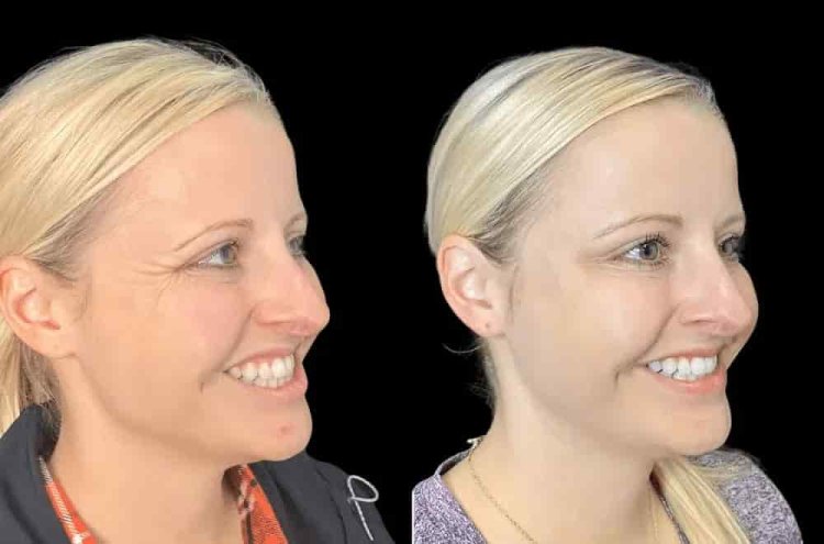 Understanding the Cost of Botox in Dubai