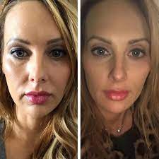 Is Thread Lift in Dubai Right for You?