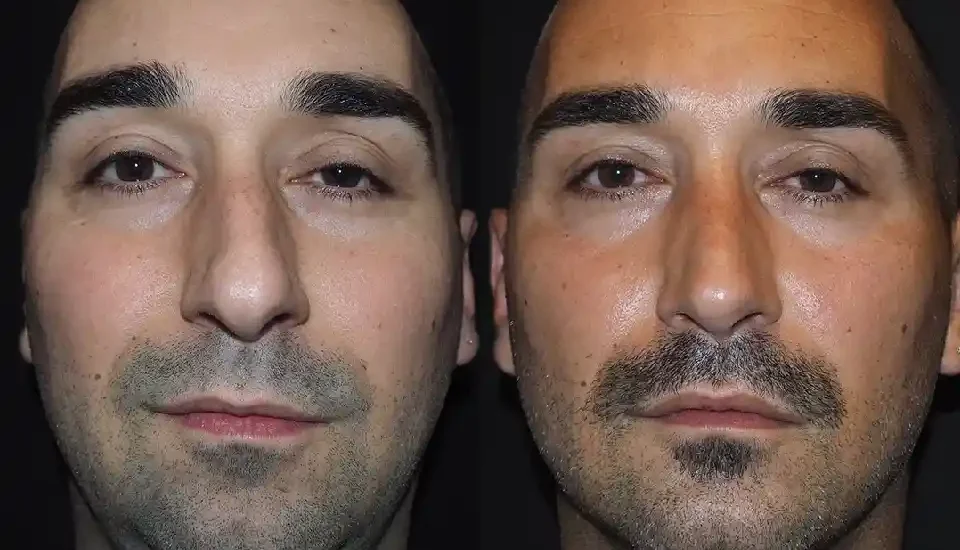 rhinoplasty in dubai