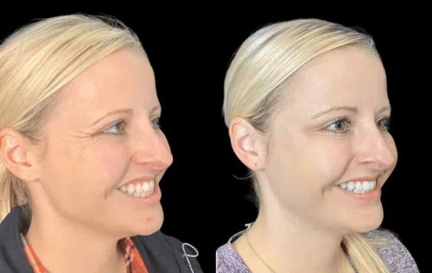 Botox