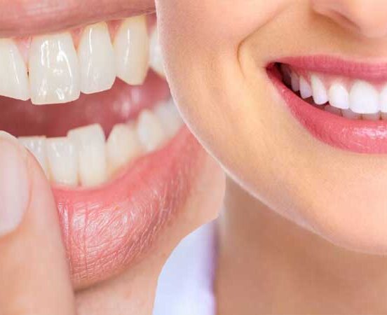 Dental Bonding Cost