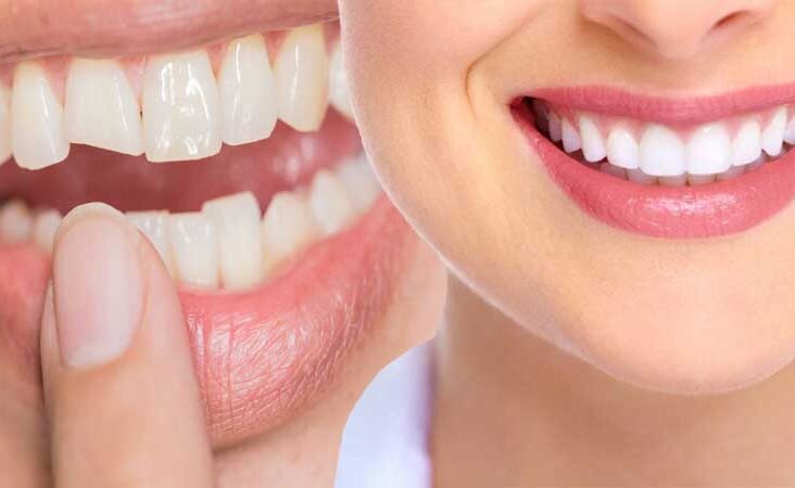 Dental Bonding Cost