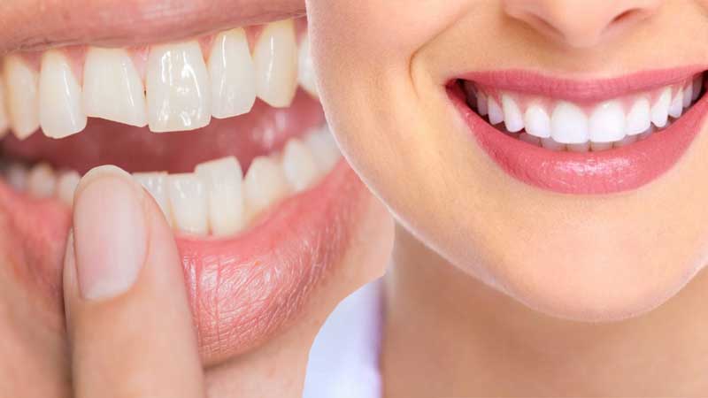 Dental Bonding Cost