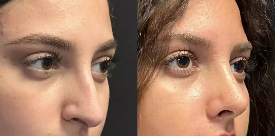 Rhinoplasty in Dubai