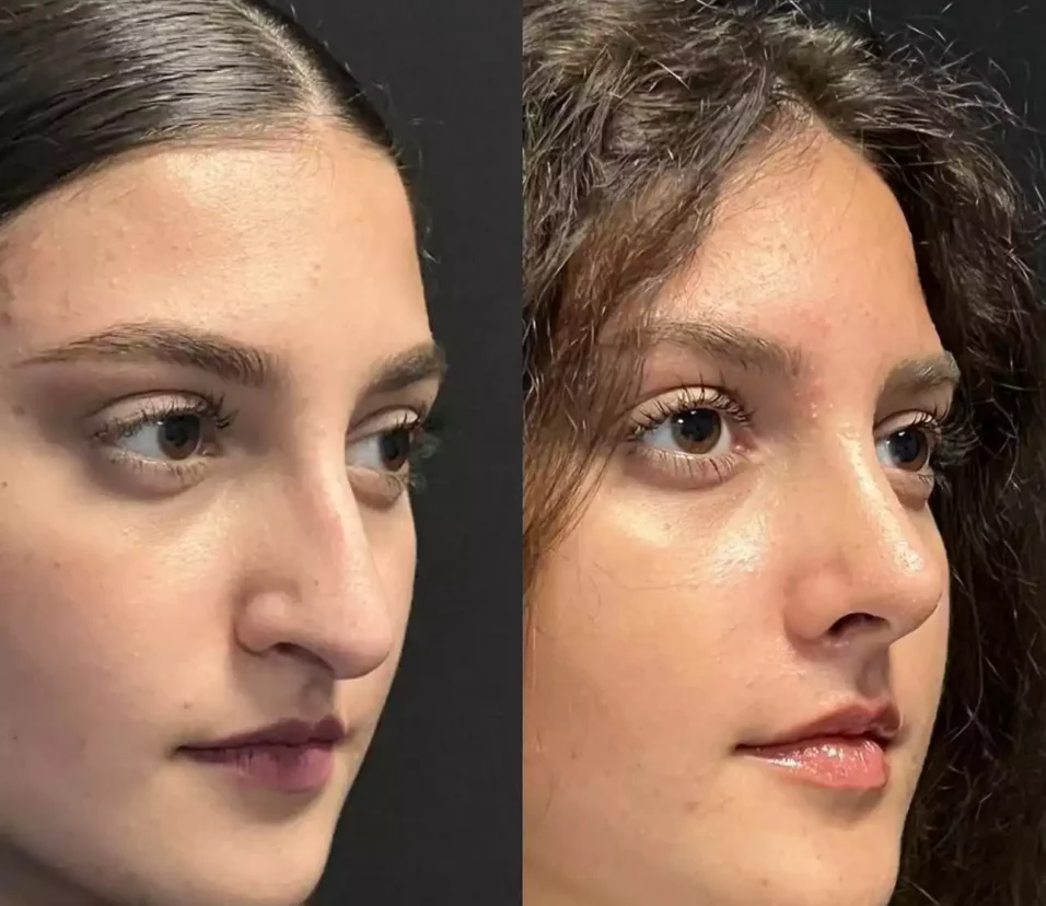 Rhinoplasty in Dubai