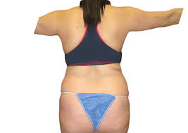 Liposuction Before And After