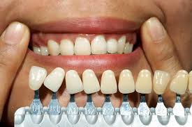cheap teeth bonding near me