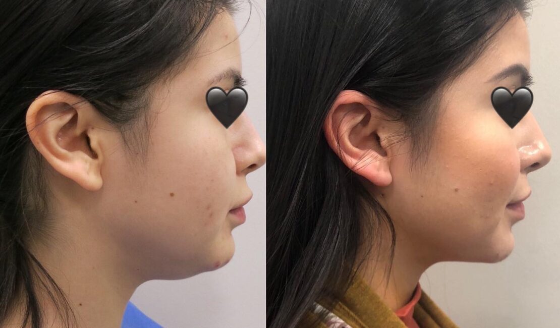 Eyelid Surgery