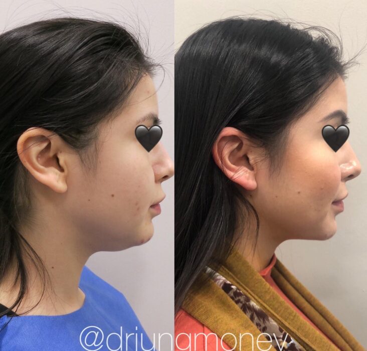 Eyelid Surgery