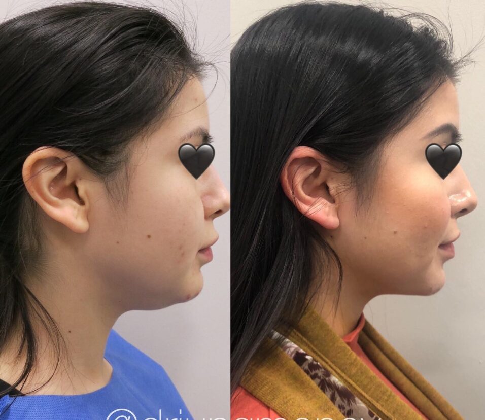 Eyelid Surgery