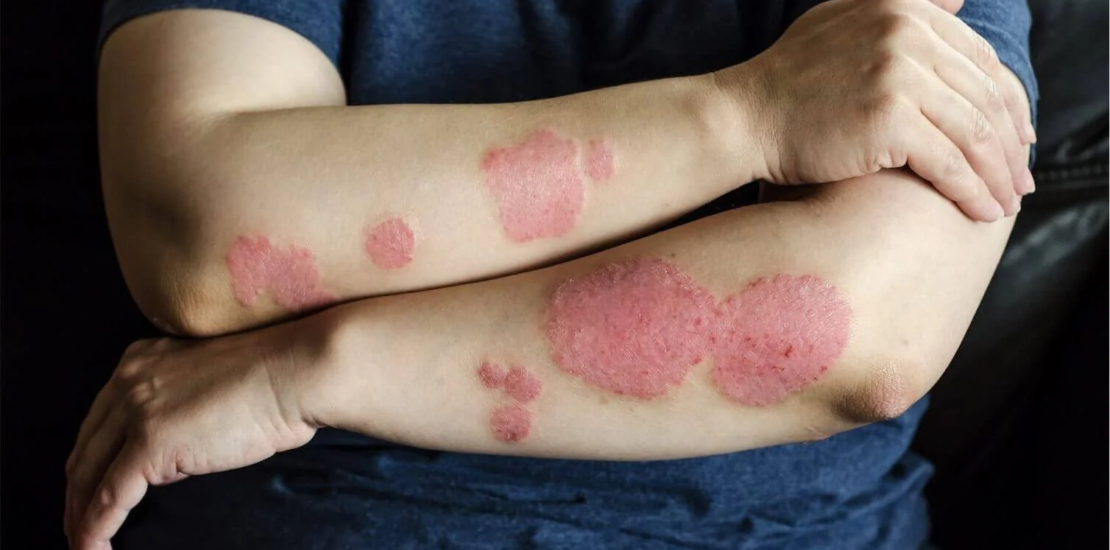 psoriasis treatment