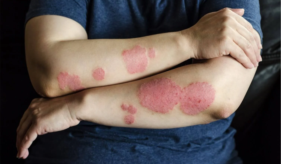 psoriasis treatment