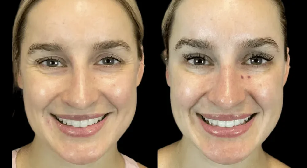 Botox in dubai