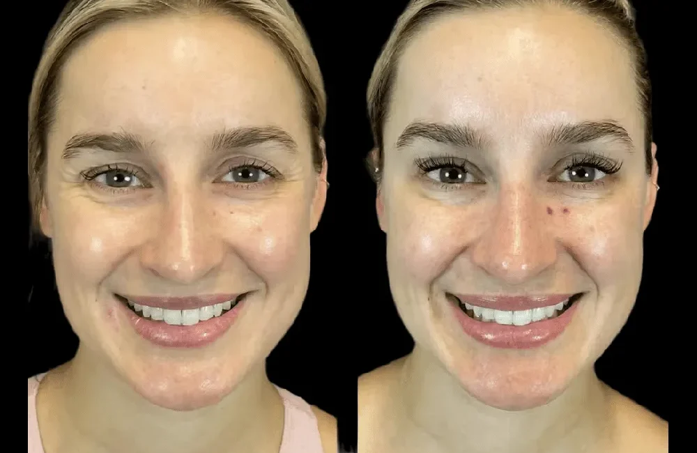 Botox in dubai