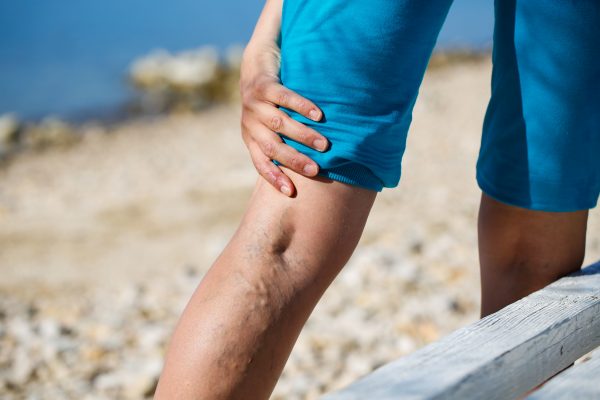 When does insurance consider varicose veins a medical necessity?