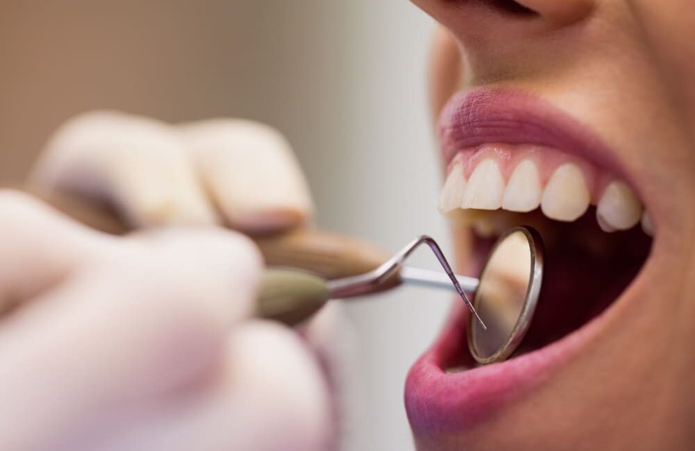 root canal