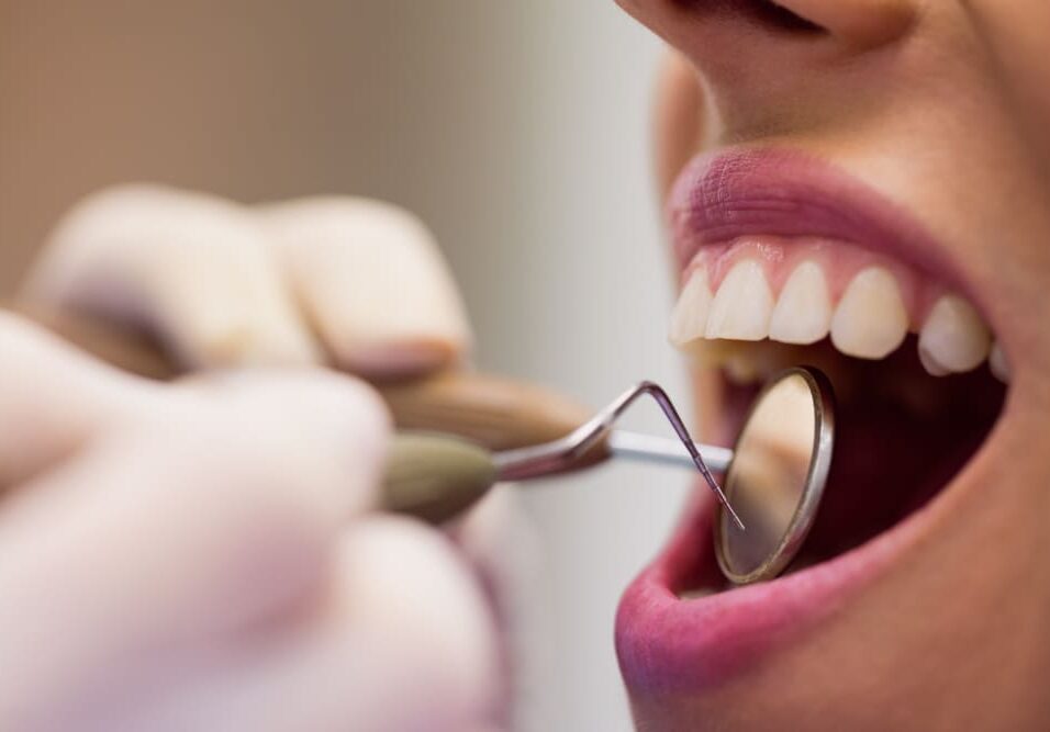root canal