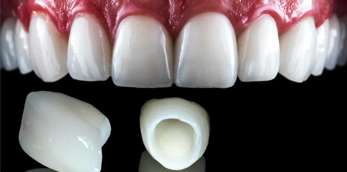 dental crown