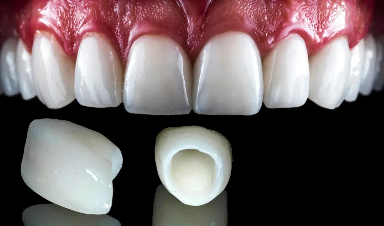 dental crown