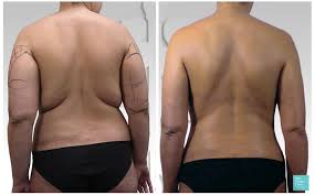 liposuction clinic near me​