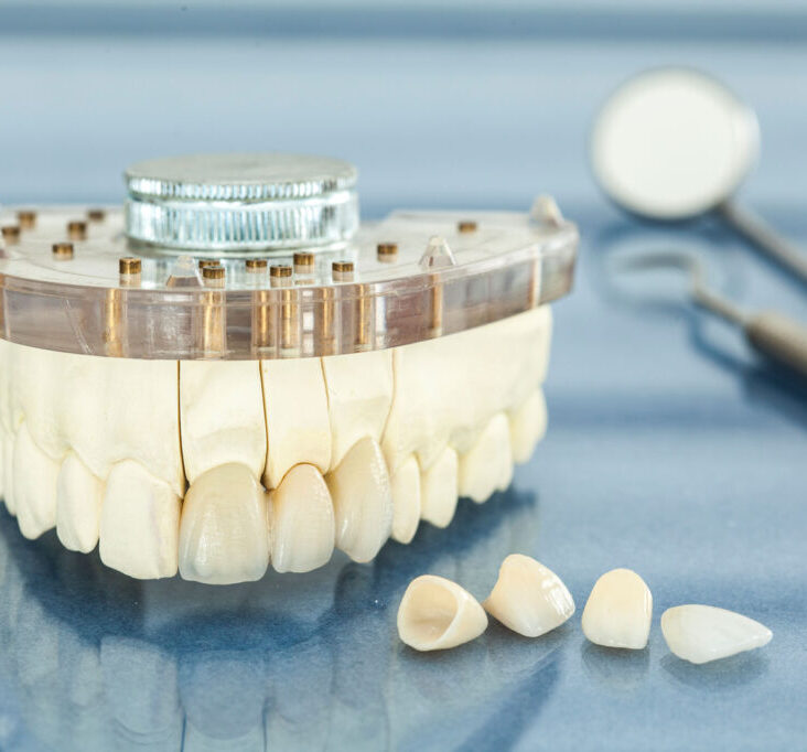 houston texas veneers
