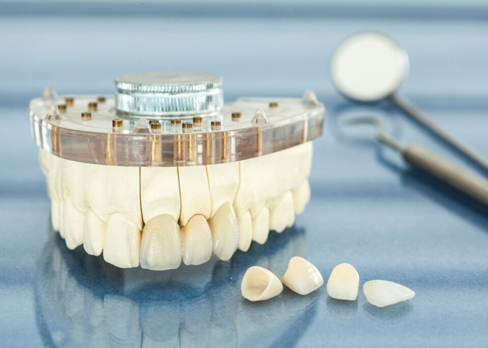 houston texas veneers