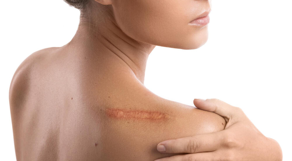 Woman with visible healed scar on the back of her right shoulder