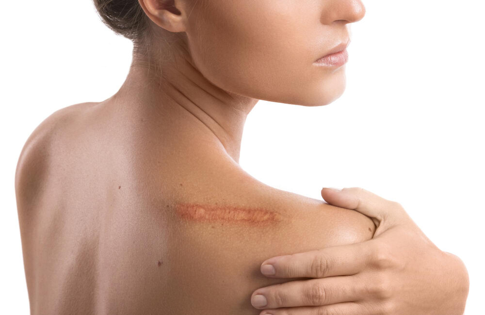 Woman with visible healed scar on the back of her right shoulder