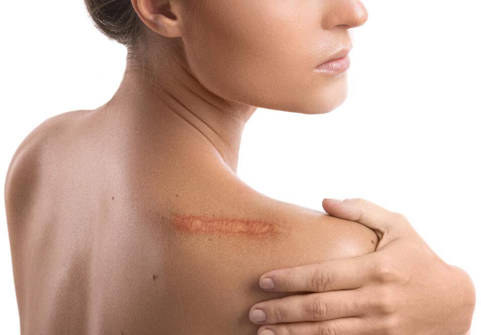 Woman with visible healed scar on the back of her right shoulder