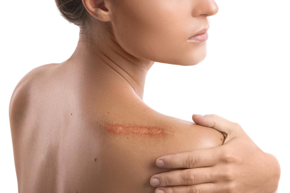 Woman with visible healed scar on the back of her right shoulder