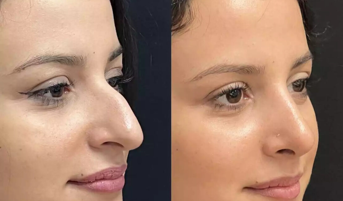Rhinoplasty in Dubai