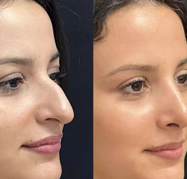 Rhinoplasty in Dubai