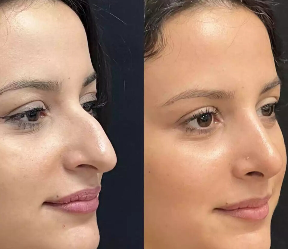 Rhinoplasty in Dubai