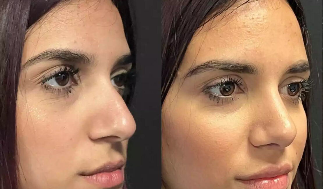 Septoplasty in Dubai