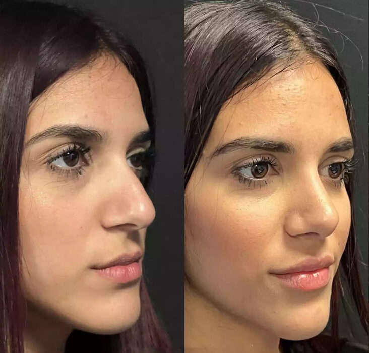 Septoplasty in Dubai