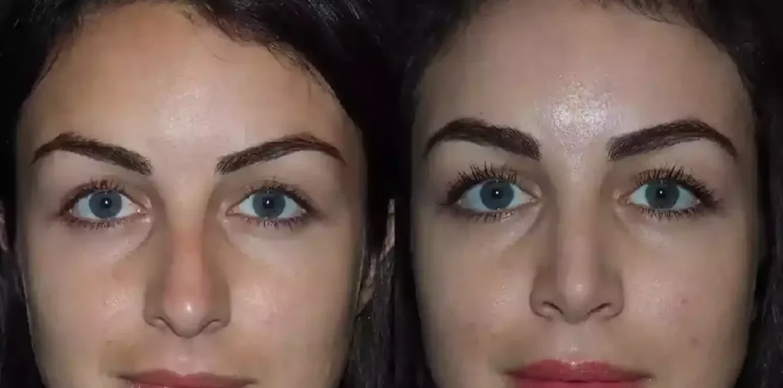 Septoplasty in Dubai