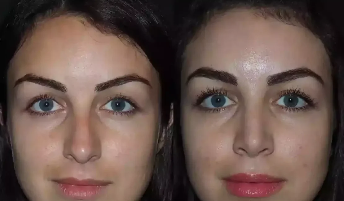 Septoplasty in Dubai