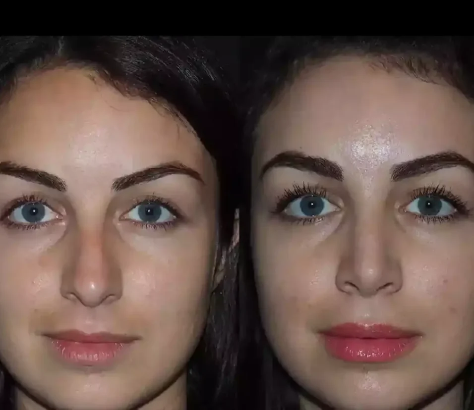 Septoplasty in Dubai