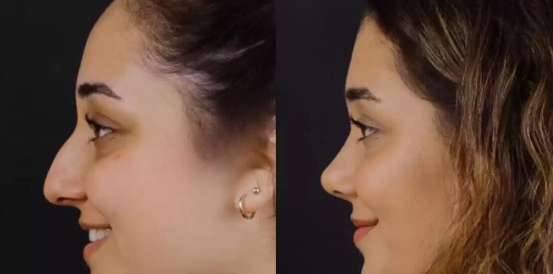 Septoplasty in Dubai