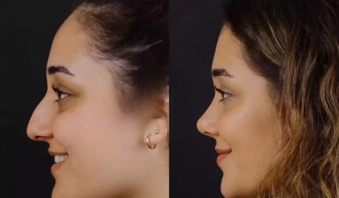 Septoplasty in Dubai