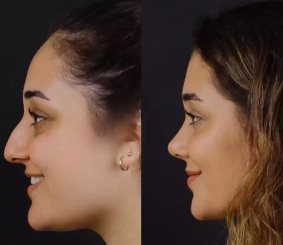 Septoplasty in Dubai