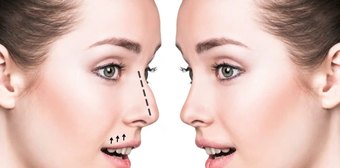 Rhinoplasty in Dubai