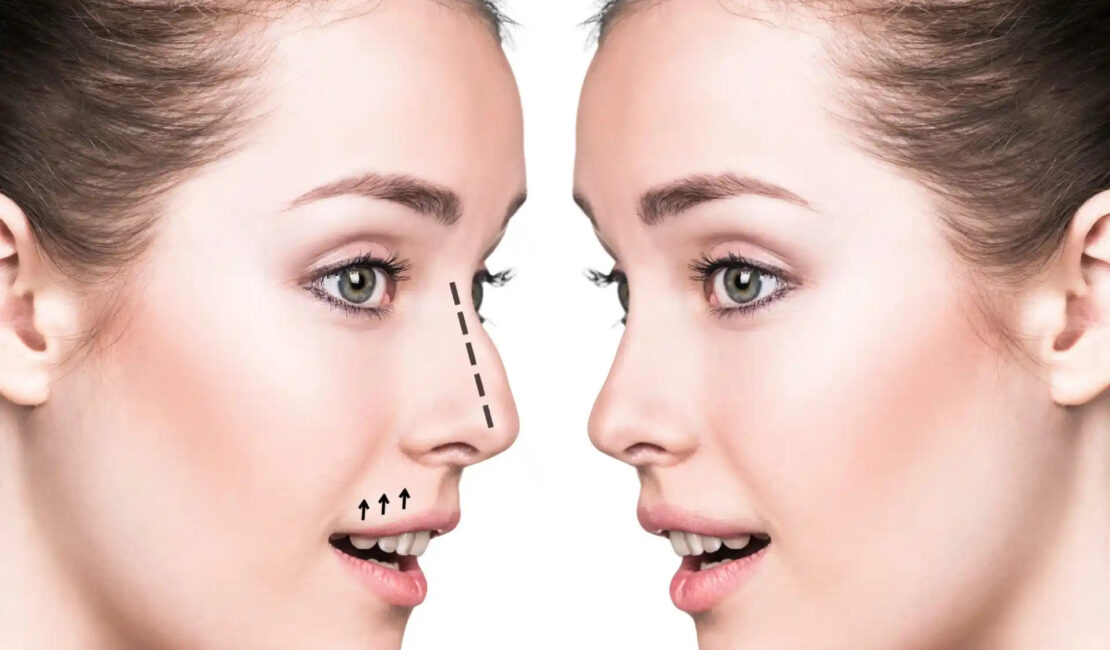 Rhinoplasty in Dubai