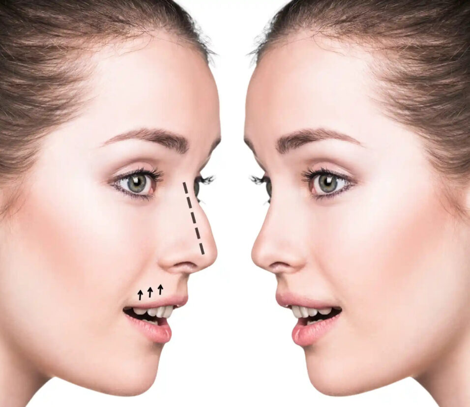 Rhinoplasty in Dubai